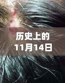历史上的11月14日,伤口缝针技术的诞生与发展探索