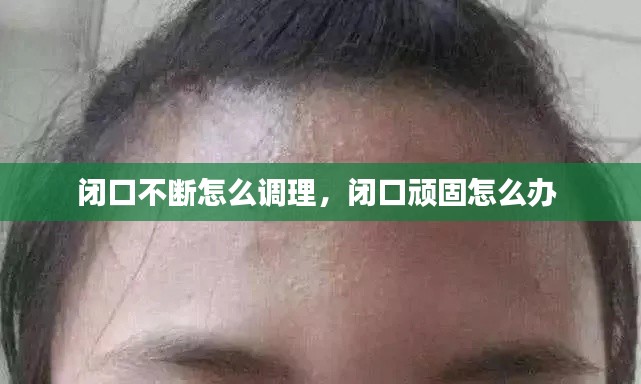 闭口不断怎么调理,闭口顽固怎么办